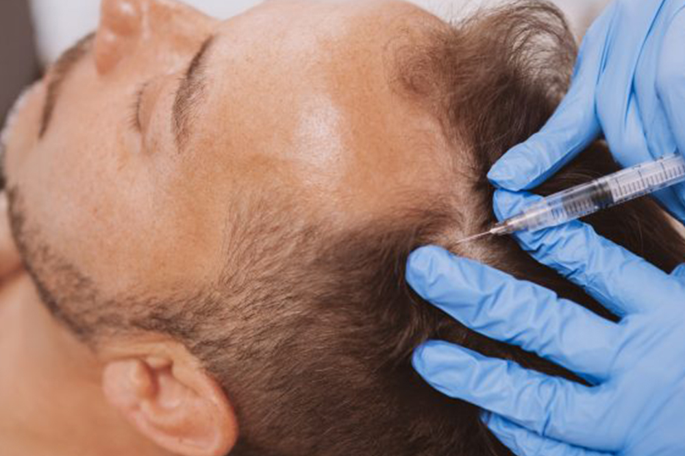 PRP for Hair Loss – Dermatology Clinic & Cosmetic Center