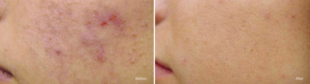 vivace before and after
