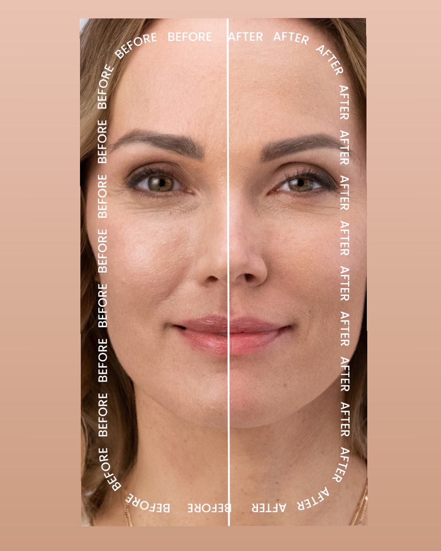 Have you tried #rhafiller ?

Expertly designed to add natural looking volume to dynamic wrinkles and folds, RHA 4 is made for results that look beautiful at rest and flawless in motion. Interested in learning more call and book with Christine - 443-388-2225

.
.
#rhacollection  #designerfiller #hafiller #rha4filler #cosmeticloungemd #ellicottcitymd